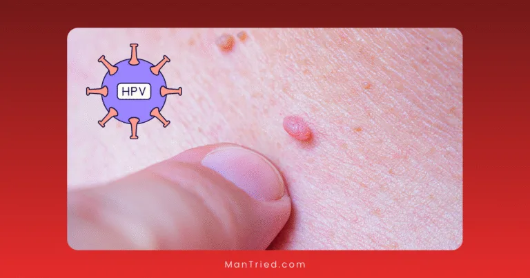 A close-up of a finger pointing to a small, raised wart on human skin, with an illustration of the HPV virus and the text "HPV in men" in a circle on the left side.